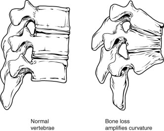 vertebras osteoporosis
